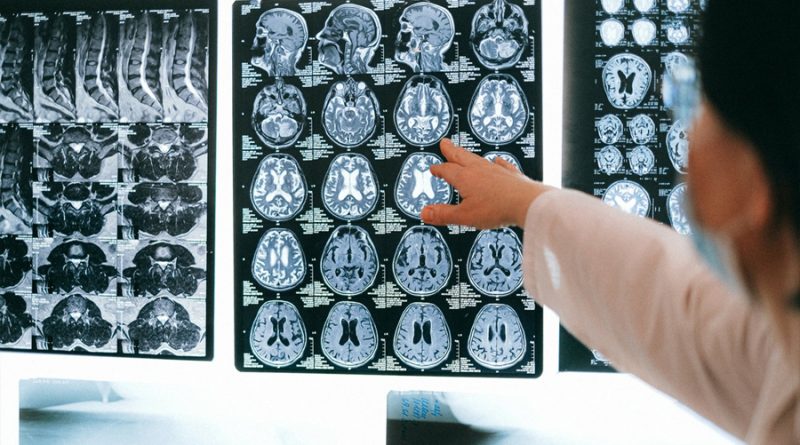 Nuevo método permite hacer mapa cerebral de los síntomas de Alzheimer