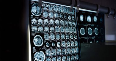 Una resonancia magnética permite ver la inflamación del cerebro ‘in vivo’ por primera vez