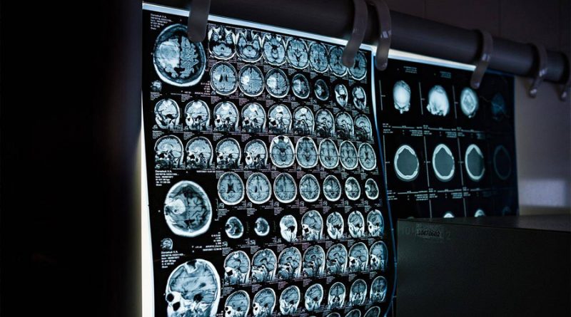 Una resonancia magnética permite ver la inflamación del cerebro ‘in vivo’ por primera vez