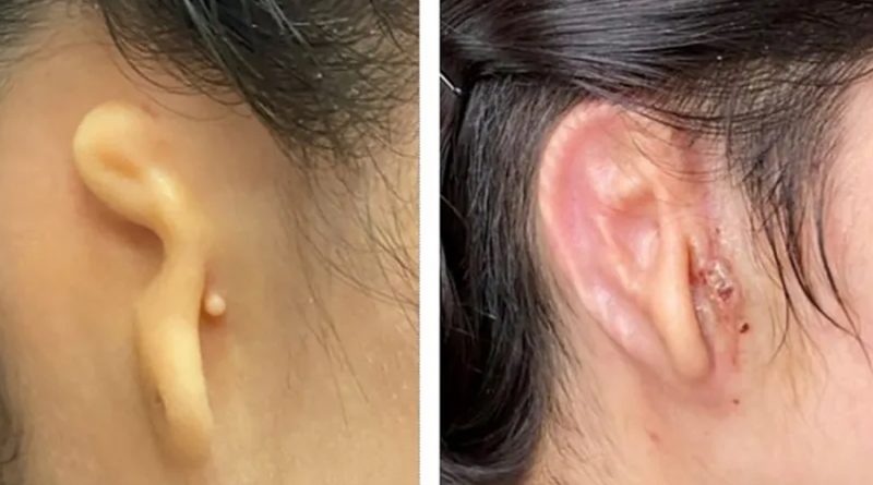 Cirujano implanta en paciente oreja impresa a partir de células humanas