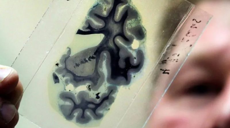 Muestran en mapa una red cerebral vinculada a las adicciones