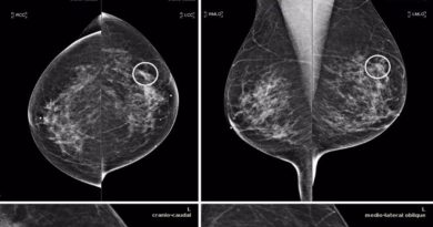 Descubren que propagación de la metástasis del cáncer de mama se acelera de noche