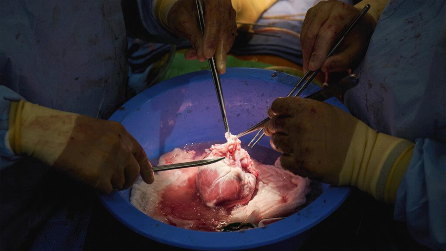 Consiguen trasplantar con éxito corazones de cerdo modificados a humanos fallecidos