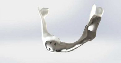 Implantación exitosa de mandíbula inferior de titanio fabricada por impresión en 3D