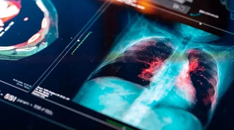 Científicos crean un nuevo componente para tratar lesiones pulmonares