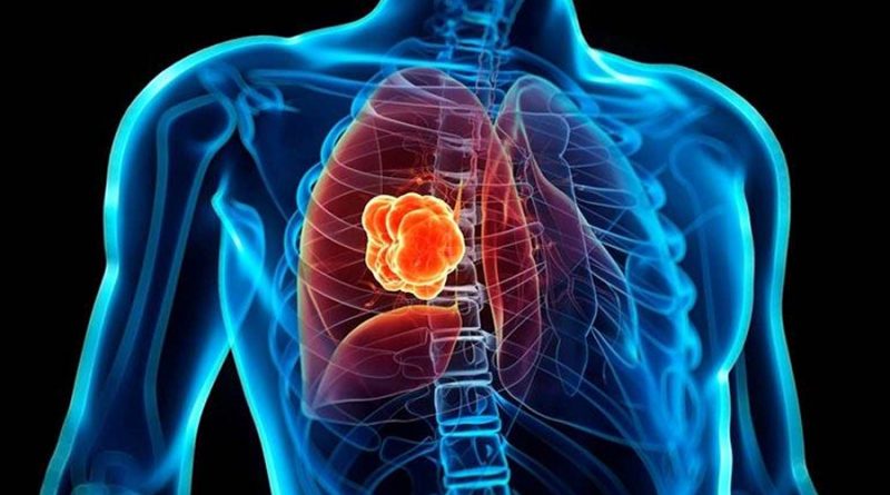 Combinación de dos fármacos detiene el cáncer de pulmón más mortal, según estudio