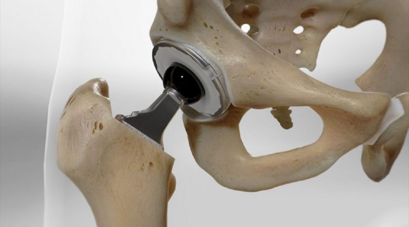 Investigadores mexicanos desarrollan un material similar al hueso para prótesis