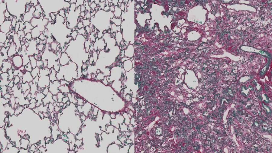 Descubren que la inmunoterapia reduce la fibrosis pulmonar y hepática en ratones