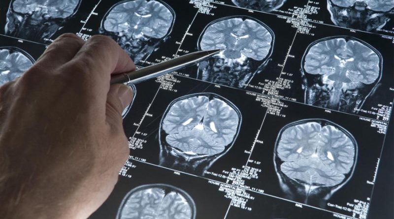 Fármaco contra el Alzheimer frena el deterioro cognitivo en ensayo clínico