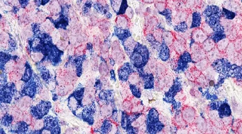 Investigadores descubren cómo las células de un tipo de cáncer de mama se vuelven resistentes a la terapia