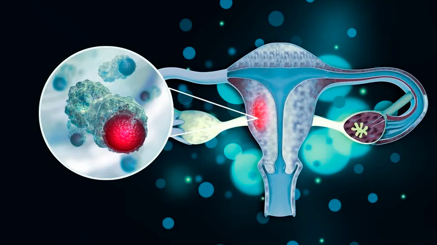 Crean un modelo de ratón que abre la investigación para tratar el cáncer de endometrio