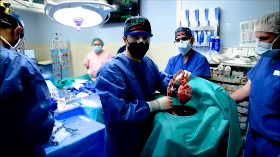 El trasplante de corazón modificado de cerdo a humano tuvo cambios inesperados