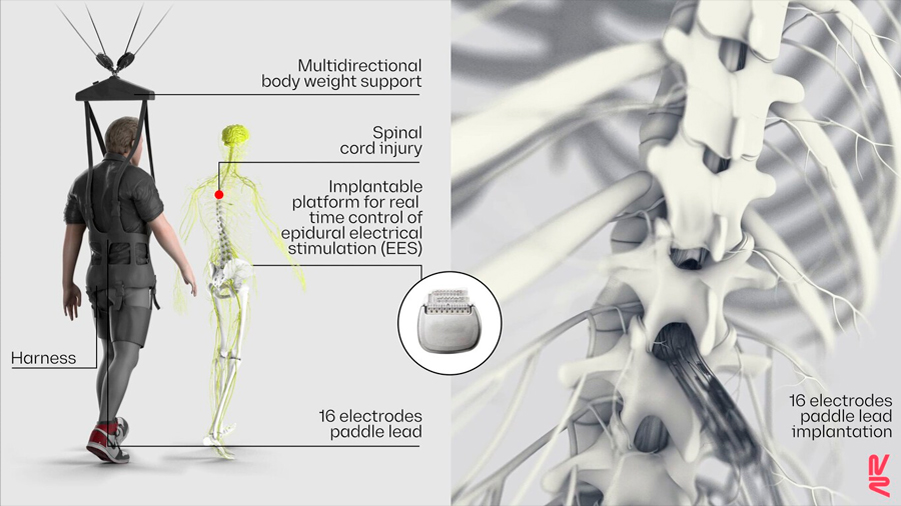 Identifican las neuronas que devuelven la capacidad de andar en pacientes con parálisis