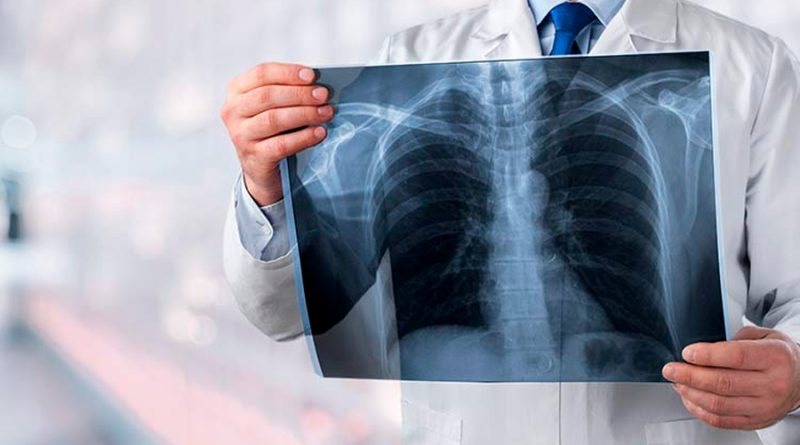 UNAM crea prueba para detectar cáncer de pulmón por medio del aliento