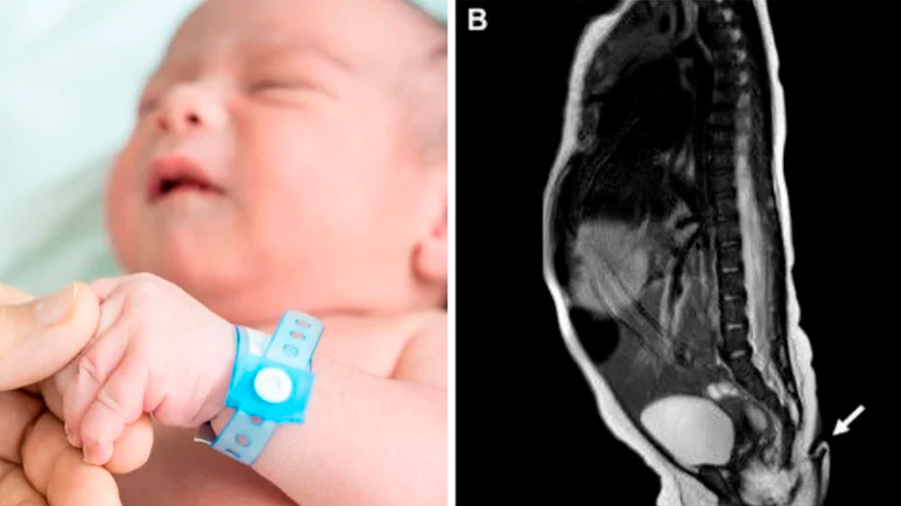 Qué dice la ciencia sobre el extraño caso de la bebé que nació con una cola de 6 centímetros en México