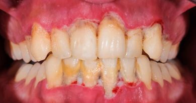 Descubren un insólito mecanismo de ataque y defensa en una bacteria causante de periodontitis
