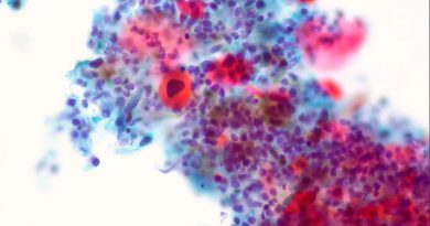 Científicos hallan un marcador de la metástasis del cáncer de próstata