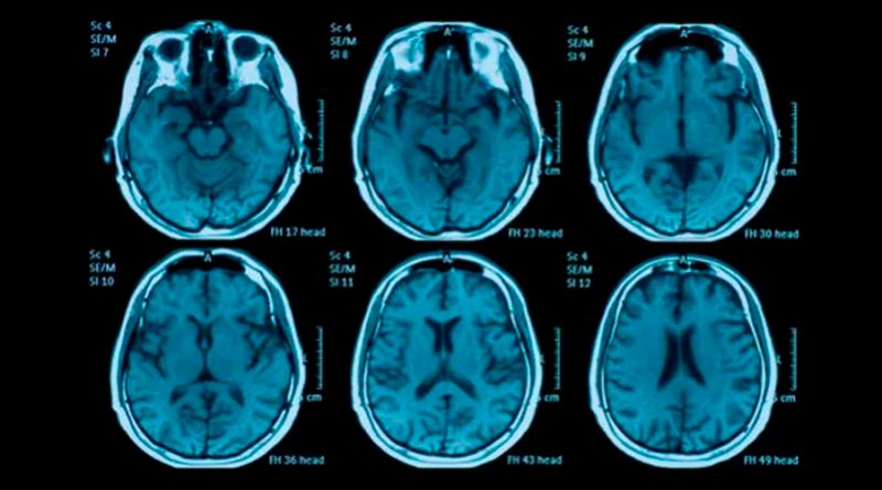 Impactante: estudio revela cuántos años envejece el cerebro tras una noche sin dormir