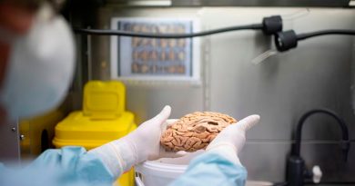 El fármaco más prometedor contra el alzhéimer encoge el cerebro de los pacientes