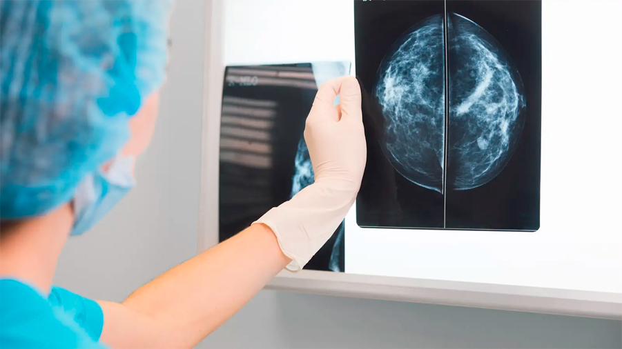 Un pequeño implante logra reducir el tumor del cáncer de mama en ratones en dos semanas
