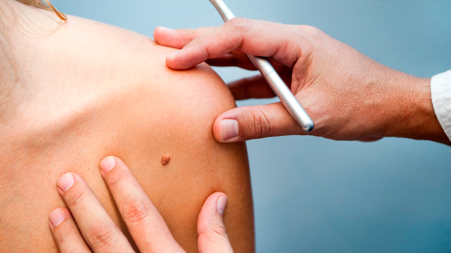 Vacuna experimental de Moderna reduce 44% recaídas por cáncer de piel