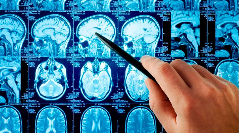 La IA revela variaciones en la anatomía cerebral de personas con autismo