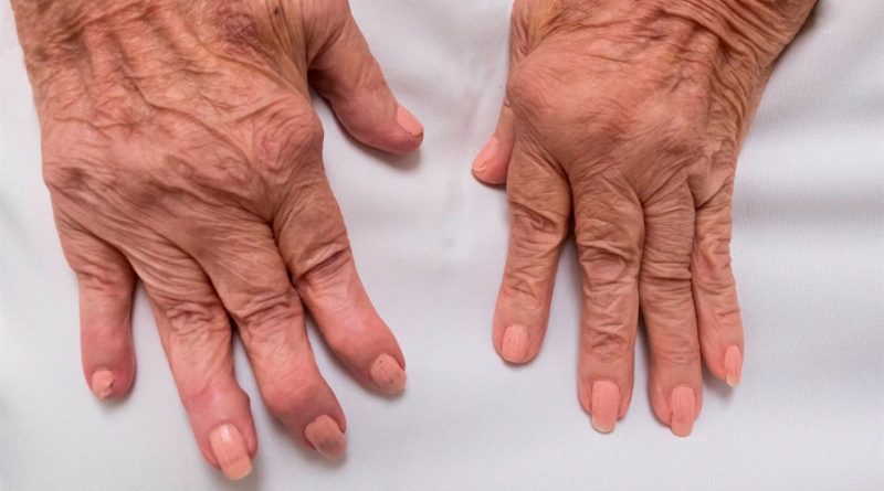 Nuevo mecanismo para acabar con la inflamación en la artritis reumatoide