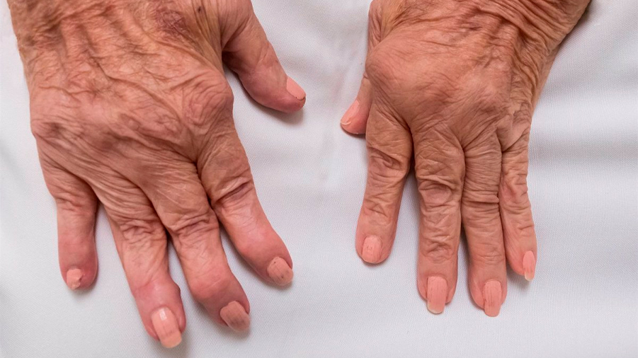 Nuevo mecanismo para acabar con la inflamación en la artritis reumatoide