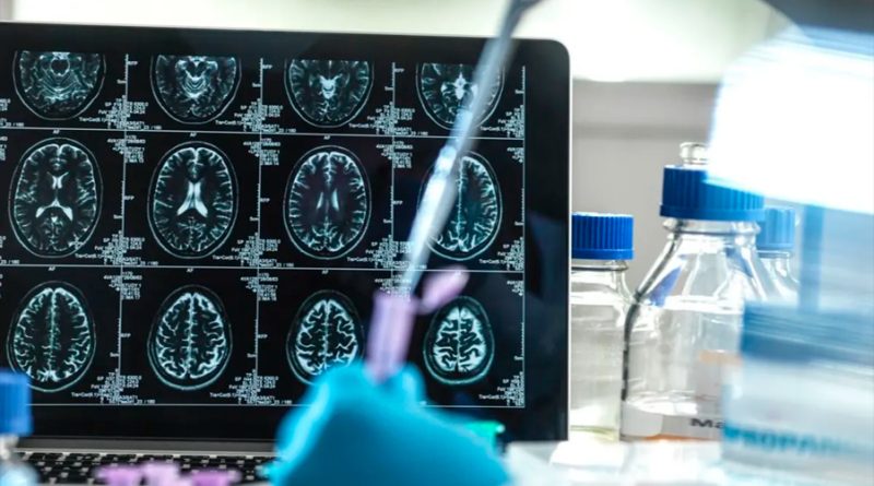 Científicos descubren en Colombia a la segunda persona resistente al alzhéimer