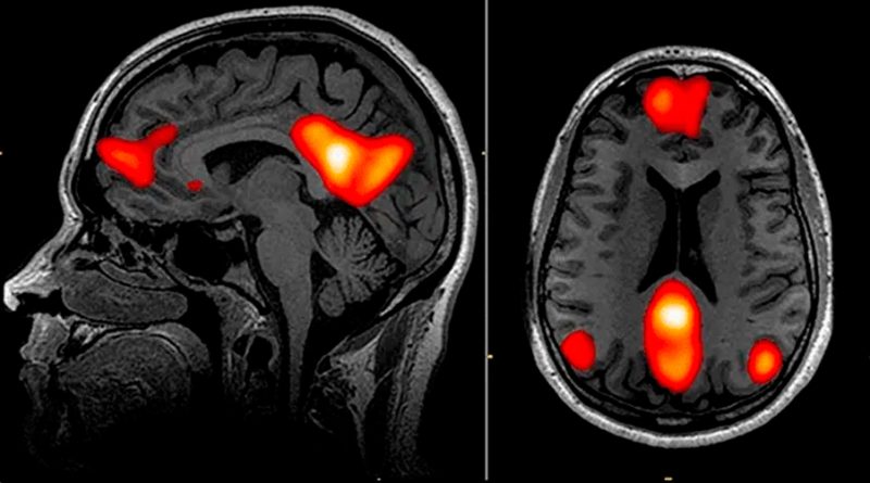 Inteligencia artificial puede detectar el Parkinson años antes de que aparezcan los síntomas