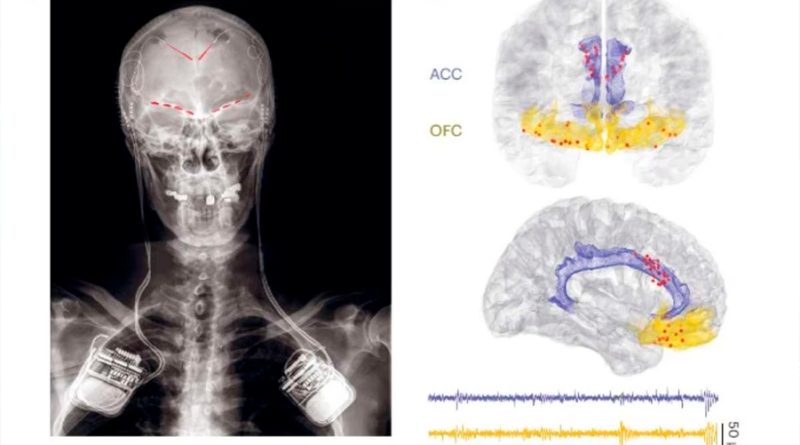 Descubren señales cerebrales que revelarían cuánto dolor siente una persona