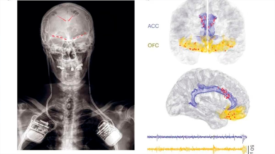 Descubren señales cerebrales que revelarían cuánto dolor siente una persona