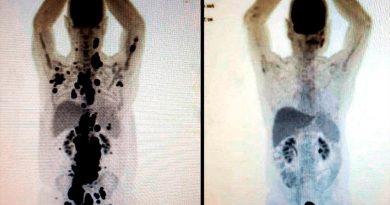 El antes y después de un paciente con cáncer que recibió prometedora terapia de células