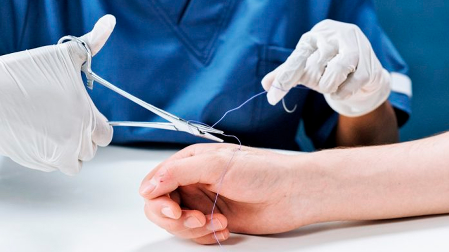 Científicos del MIT crean nuevas suturas que derivan de tejido animal