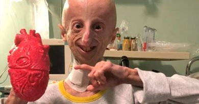 Progeria: los pasos de los últimos 20 años muestran 'cierta esperanza' en los tratamientos
