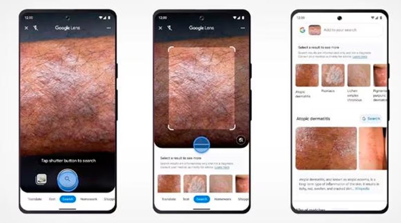 Cómo usar Google Lens para identificar mancha en la piel, desde lunares hasta afecciones graves