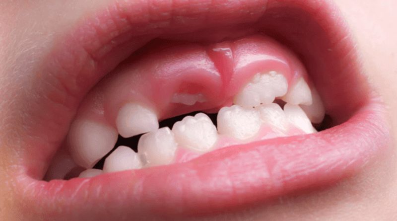 Así funciona el fármaco experimental que podría regenerar los dientes caídos