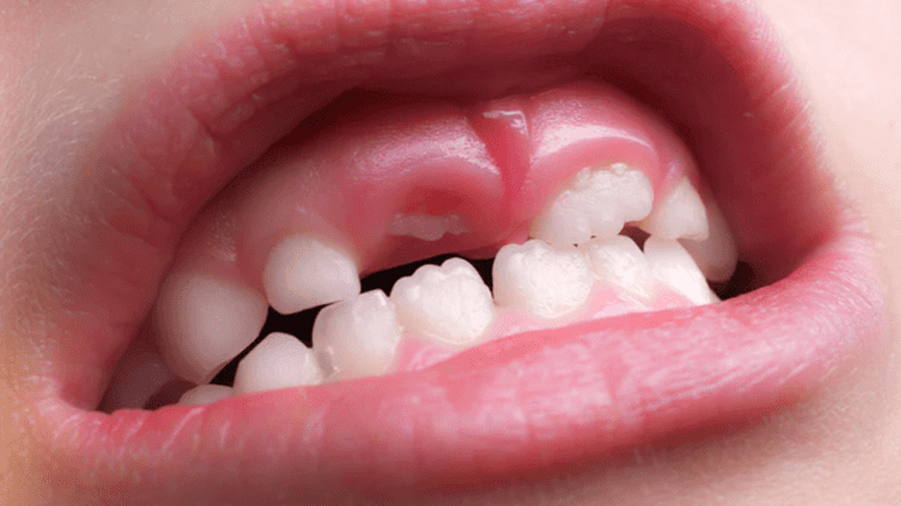 Así funciona el fármaco experimental que podría regenerar los dientes caídos