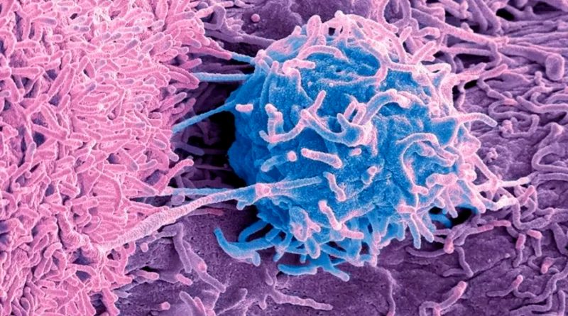Cáncer: el misterio de los microbios que viven dentro de los tumores