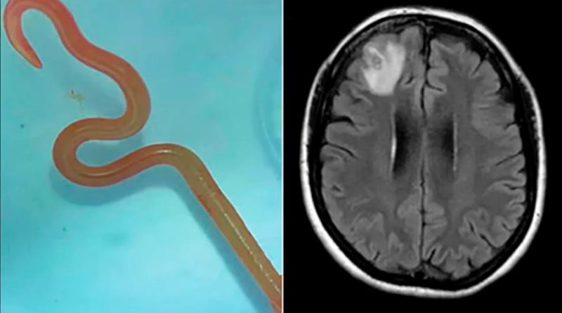 Extraen del cerebro de una australiana una lombriz intestinal viva de 8 centímetros