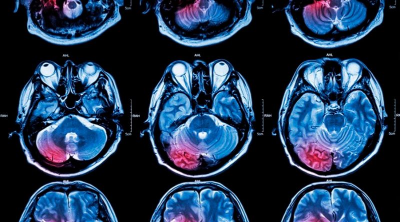 Un estudio muestra cómo los tumores cerebrales hacen que ciertas células inmunes se vuelvan traidoras