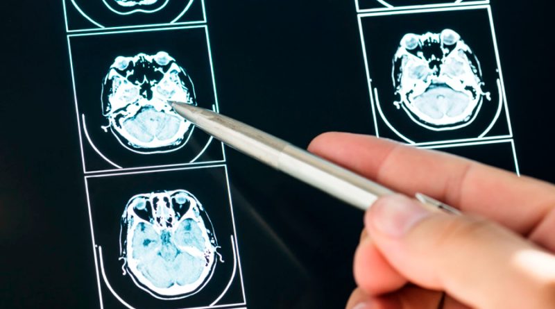 Identifican los tres factores que más aceleran el envejecimiento del cerebro, según Oxford