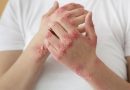 ¿Cómo afecta la psoriasis a la familia de quien la padece?