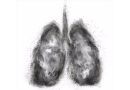 Descubren acumulación de algo parecido al hollín en células pulmonares de pacientes con EPOC