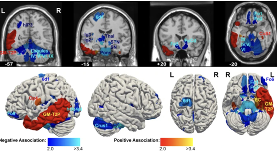 La ciencia revela una imagen escalofriante del cerebro de un psicópata
