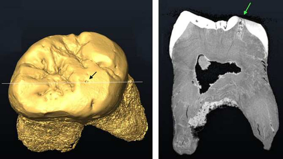 Usar la boca como una tercera mano pudo causar la última caries descubierta en un fósil neandertal