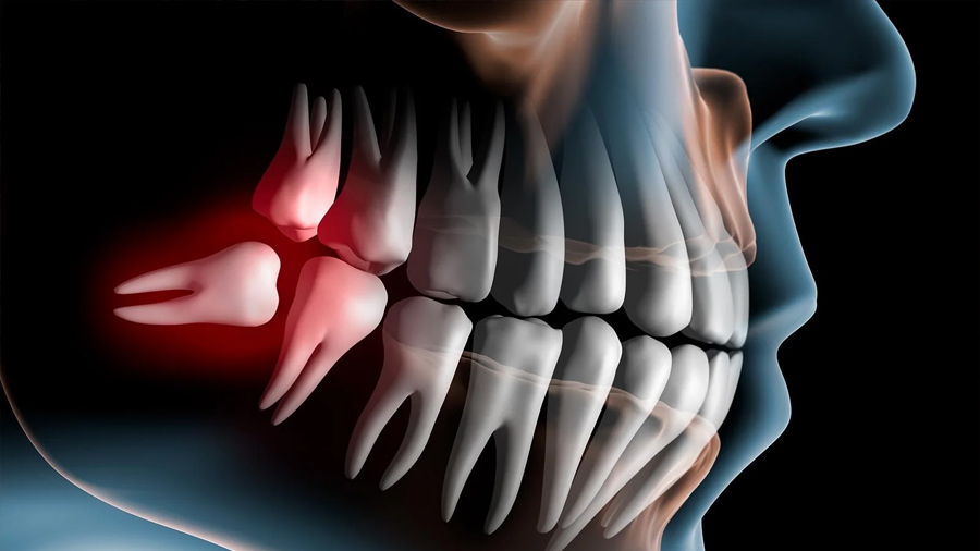 ¿Desaparecerán las muelas del juicio?