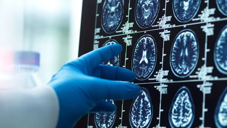 Crean nanoimplantes cerebrales que sustituyen a la cirugía para curar enfermedades como el alzhéimer