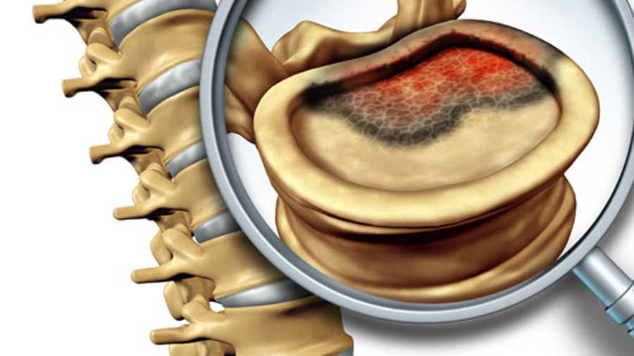 Investigadores españoles descubren el origen del Sarcoma de Ewing