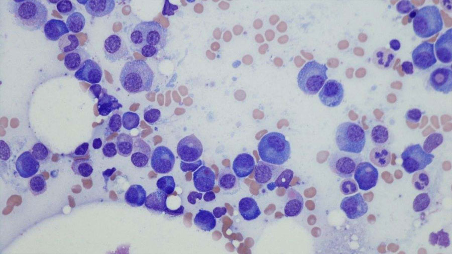 Investigadores españoles descubren que fármacos para el cáncer podrían tratar la rara anemia de Diamond-Blackfan